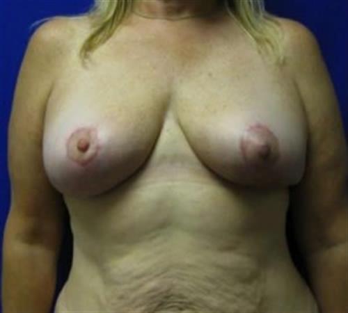 Breast Lift Before and After | SGK Plastic Surgery