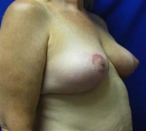 Breast Lift Before and After | SGK Plastic Surgery