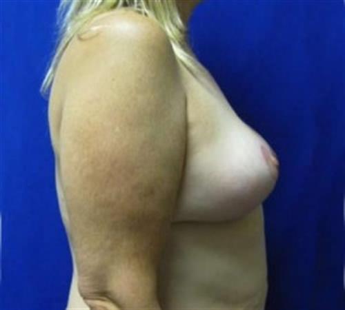 Breast Lift Before and After | SGK Plastic Surgery