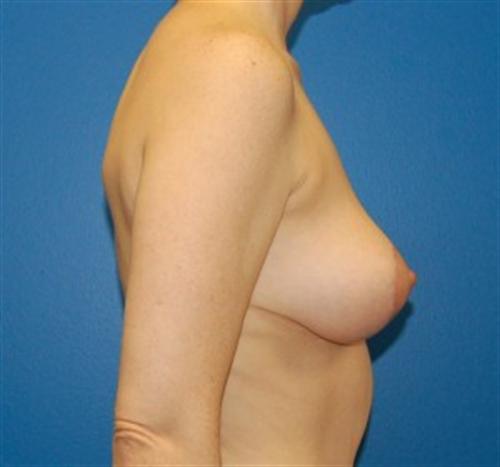 Breast Lift Before and After | SGK Plastic Surgery