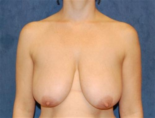 Breast Lift Before and After | SGK Plastic Surgery