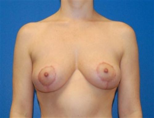 Breast Lift Before and After | SGK Plastic Surgery