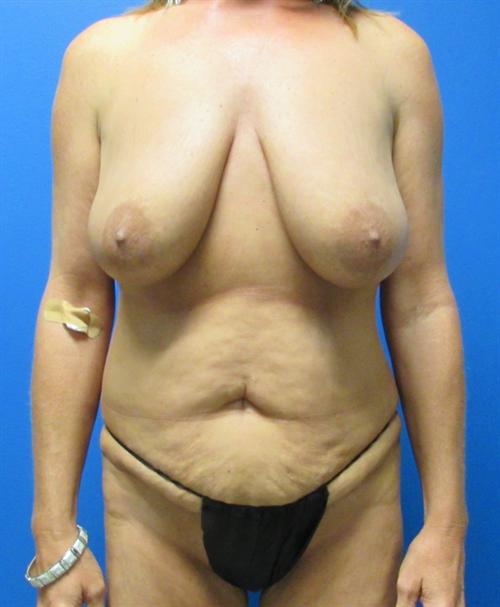 Breast Lift Before and After | SGK Plastic Surgery