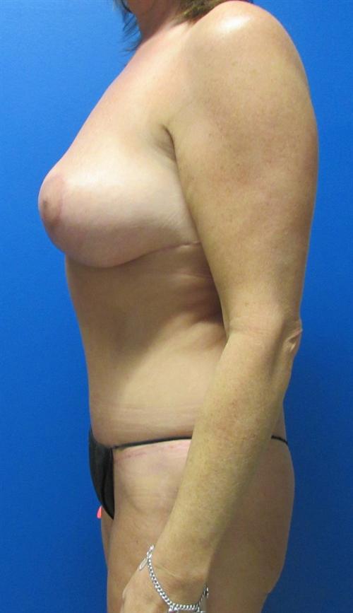 Breast Lift Before and After | SGK Plastic Surgery