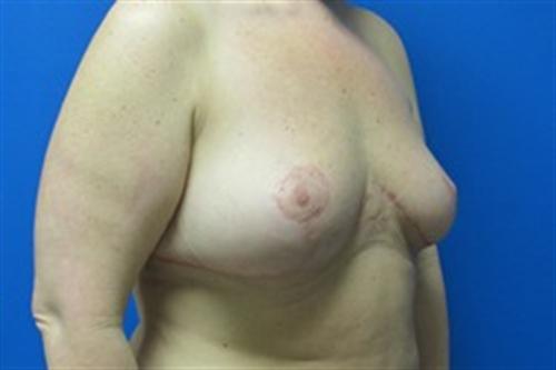 Breast Lift Before and After | SGK Plastic Surgery