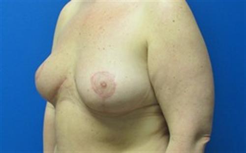 Breast Lift Before and After | SGK Plastic Surgery