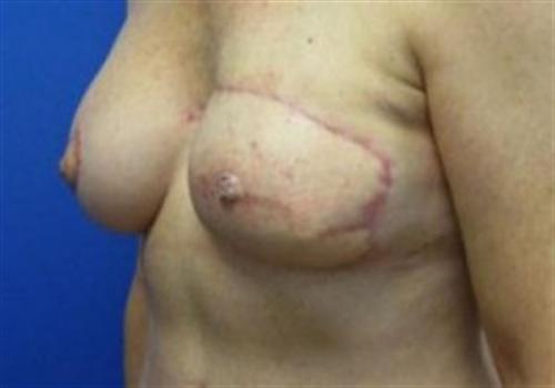 Breast Reconstruction Before and After | SGK Plastic Surgery