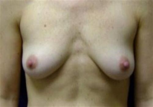 Breast Reconstruction in The Woodlands