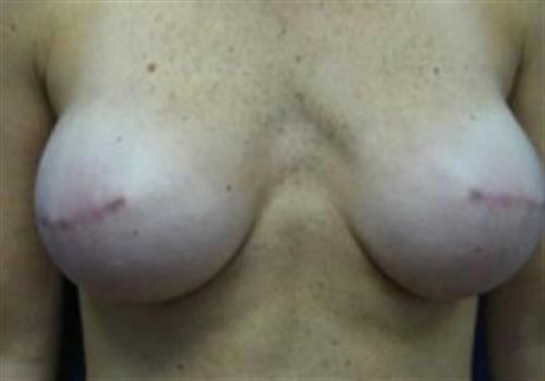 Breast Reconstruction in The Woodlands