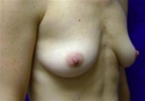 Breast Reconstruction Before and After | SGK Plastic Surgery