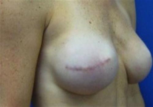 Breast Reconstruction Before and After | SGK Plastic Surgery