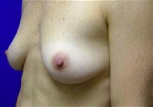 Breast Reconstruction Before and After | SGK Plastic Surgery