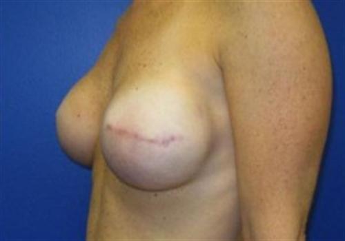 Breast Reconstruction Before and After | SGK Plastic Surgery