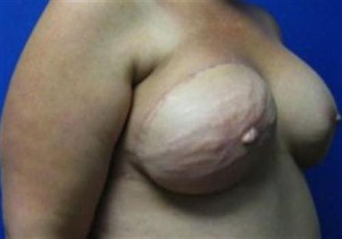 Breast Reconstruction Before and After | SGK Plastic Surgery