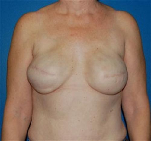 Breast Reconstruction Before and After | SGK Plastic Surgery