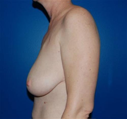 Breast Reconstruction Before and After | SGK Plastic Surgery