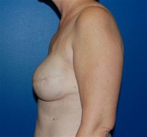 Breast Reconstruction Before and After | SGK Plastic Surgery