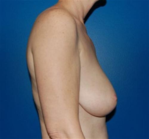 Breast Reconstruction Before and After | SGK Plastic Surgery