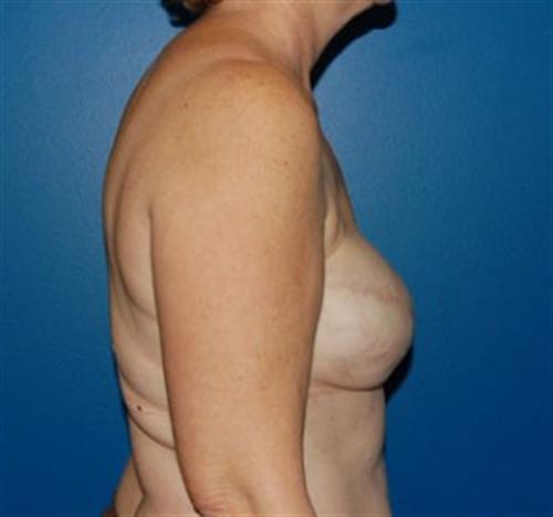 Breast Reconstruction Before and After | SGK Plastic Surgery