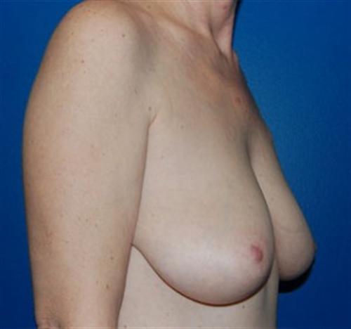 Breast Reconstruction Before and After | SGK Plastic Surgery