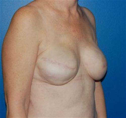 Breast Reconstruction Before and After | SGK Plastic Surgery