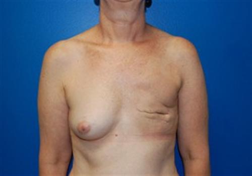 Breast Reconstruction Before and After | SGK Plastic Surgery