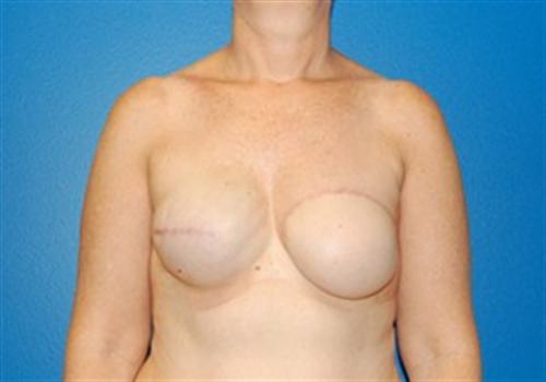 Breast Reconstruction Before and After | SGK Plastic Surgery