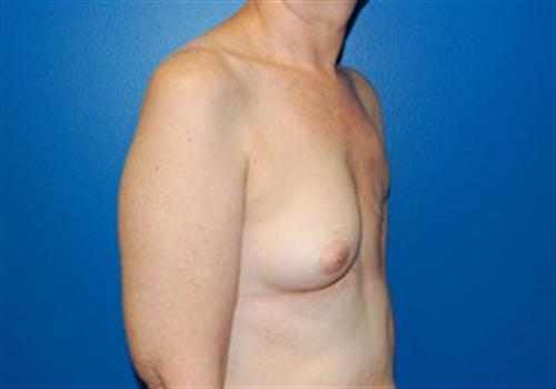 Breast Reconstruction Before and After | SGK Plastic Surgery