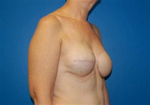 Breast Reconstruction Before and After | SGK Plastic Surgery