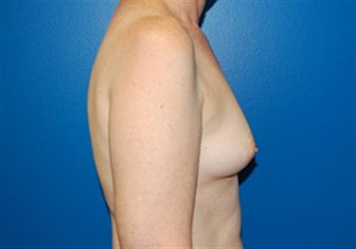 Breast Reconstruction Before and After | SGK Plastic Surgery