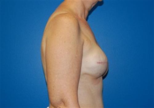 Breast Reconstruction Before and After | SGK Plastic Surgery