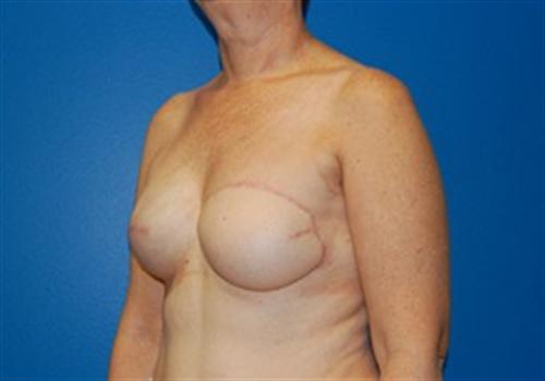 Breast Reconstruction Before and After | SGK Plastic Surgery