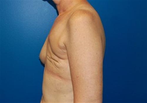 Breast Reconstruction Before and After | SGK Plastic Surgery