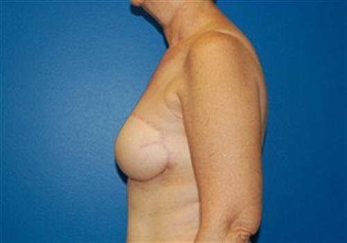 Breast Reconstruction Before and After | SGK Plastic Surgery