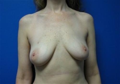 Breast Reconstruction Before and After | SGK Plastic Surgery