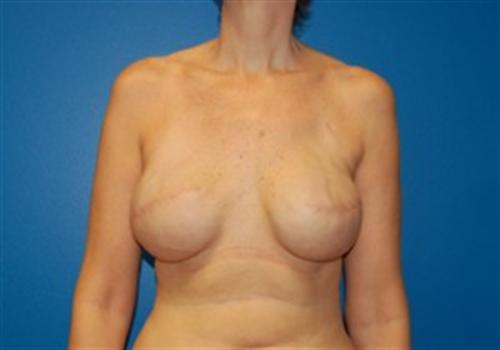 Breast Reconstruction Before and After | SGK Plastic Surgery