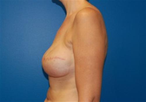 Breast Reconstruction Before and After | SGK Plastic Surgery