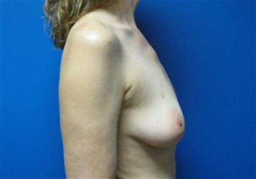 Breast Reconstruction Before and After | SGK Plastic Surgery