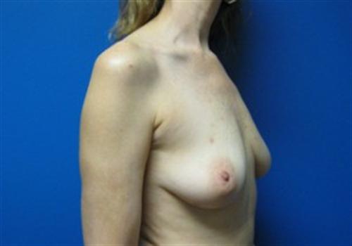 Breast Reconstruction Before and After | SGK Plastic Surgery