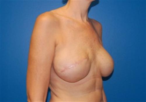 Breast Reconstruction Before and After | SGK Plastic Surgery