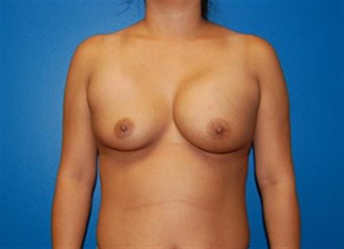 Breast Reconstruction Before and After | SGK Plastic Surgery