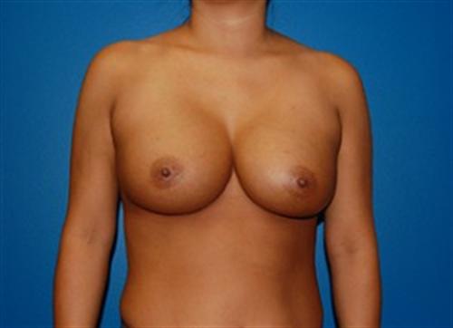 Breast Reconstruction Before and After | SGK Plastic Surgery