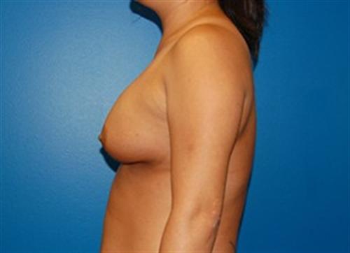 Breast Reconstruction Before and After | SGK Plastic Surgery