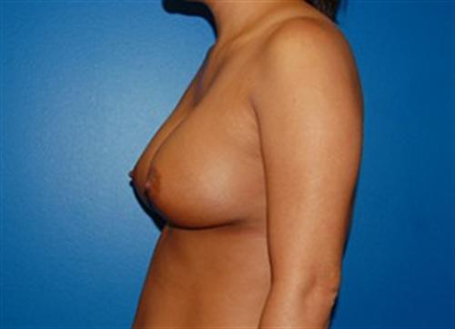 Breast Reconstruction Before and After | SGK Plastic Surgery