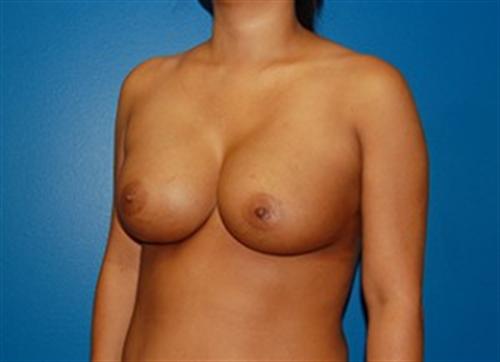 Breast Reconstruction Before and After | SGK Plastic Surgery