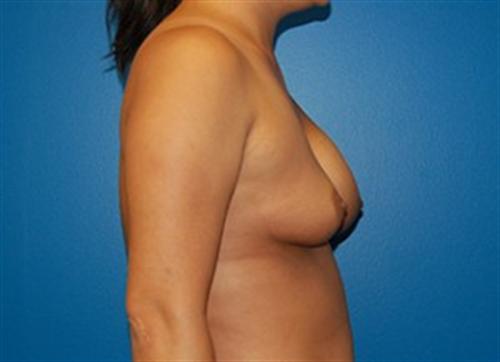 Breast Reconstruction Before and After | SGK Plastic Surgery