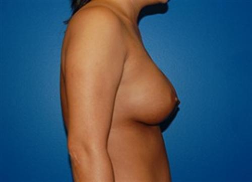 Breast Reconstruction Before and After | SGK Plastic Surgery