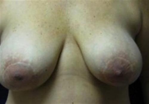 Breast Reconstruction Before and After | SGK Plastic Surgery