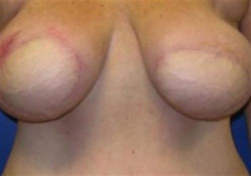 Breast Reconstruction Before and After | SGK Plastic Surgery