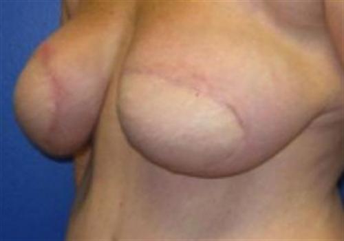 Breast Reconstruction Before and After | SGK Plastic Surgery